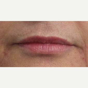 55-64 year old woman treated with Restylane Silk Lip Augmentation after 1704612