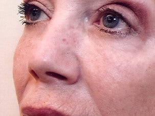 Injectable Fillers after 1076884