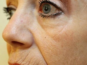Injectable Fillers before 1076884