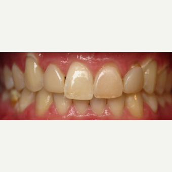 25-34 year old man treated with Dental Crowns before 3260755