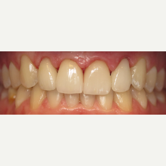 25-34 year old man treated with Dental Crowns after 3260755