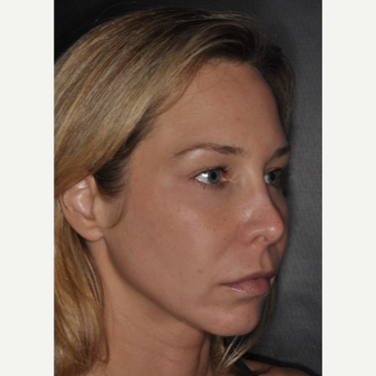 35-44 year old woman treated with Brow Lift 2 weeks post-op before 3452207