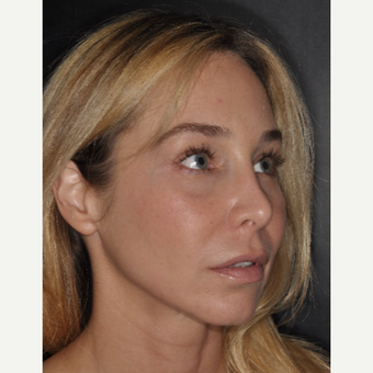 35-44 year old woman treated with Brow Lift 2 weeks post-op after 3452207