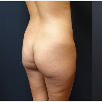 25-34 year old woman treated with Liposuction before 3731922