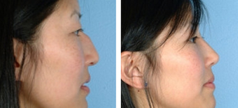 Asian Eyelid Surgery before 1208228