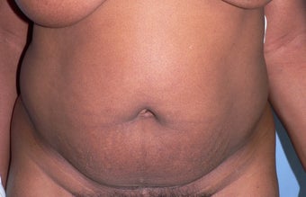 5 year post op TT with mesh before 1207705