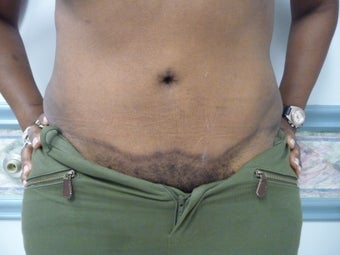 5 year post op TT with mesh after 1207705