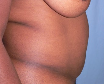 5 year post op TT with mesh 1207705