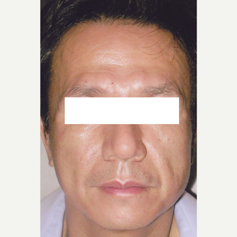 54 year old man treated with Botox, HA Filler, Sculptra before 3056192
