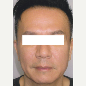 54 year old man treated with Botox, HA Filler, Sculptra after 3056192