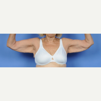 63 year old woman treated with Posterior Arm Lift before 3228519
