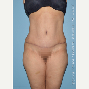 45-54 year old woman treated with Tummy Tuck after 3691157