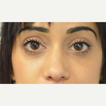 25-34 year old woman treated with Perlane to her lower eyelids and cheeks after 2827933
