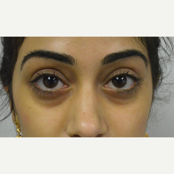 25-34 year old woman treated with Perlane to her lower eyelids and cheeks before 2827933