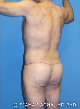 Body Lift 216781