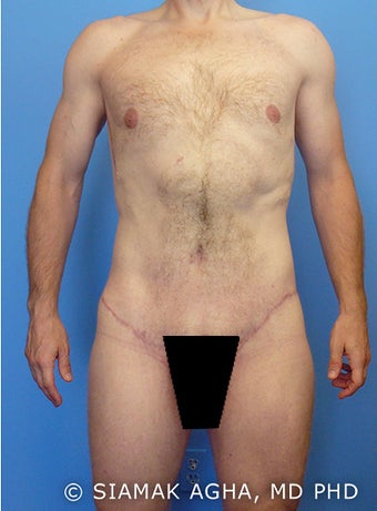 Body Lift after 216781