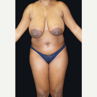 35-44 year old woman treated with Breast Reduction before 3332927
