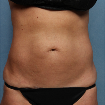 45-54 year old woman treated with CoolSculpting after 3224498