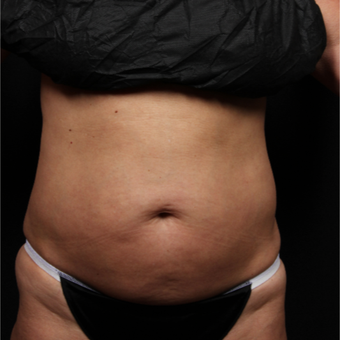 45-54 year old woman treated with CoolSculpting before 3224498