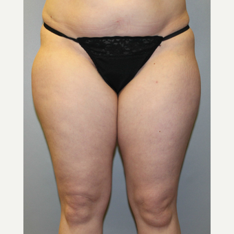 35-44 year old woman treated with Liposuction before 3589579
