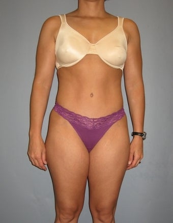 33 year old Tummy Tuck patient 1325302
