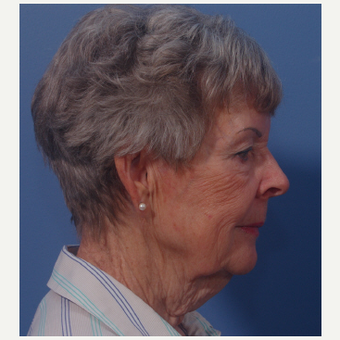 75 and up year old woman treated with Facelift before 3749108