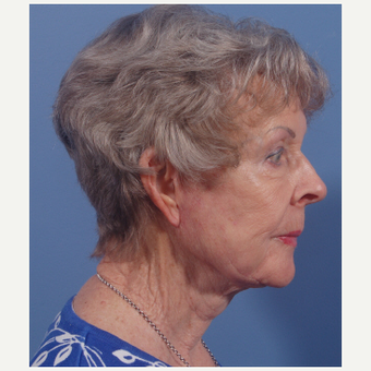 75 and up year old woman treated with Facelift after 3749108
