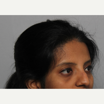 25-34 year old woman treated with Rhinoplasty before 3424439