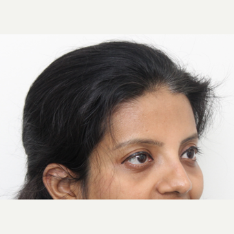 25-34 year old woman treated with Rhinoplasty after 3424439