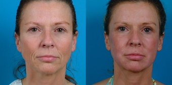 45-year-old woman treated with Facial Fat Transfer. before 574293