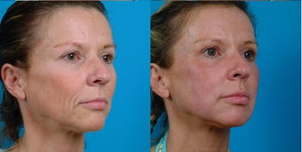 45-year-old woman treated with Facial Fat Transfer. after 574293