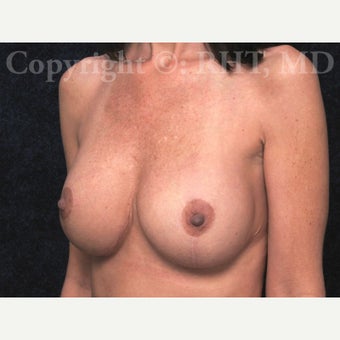 41year old woman with loss of breast volume and loose skin underwent full Breast Lift with Implants. 1912607