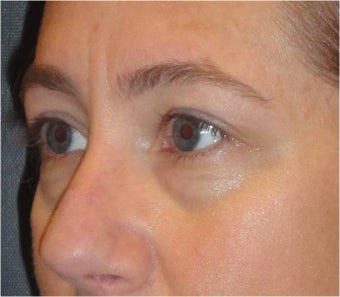 Restylane before 674576