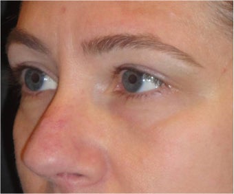 Restylane after 674576