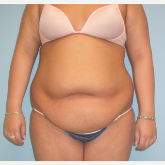 20 year old woman treated with Tummy Tuck before 3375471