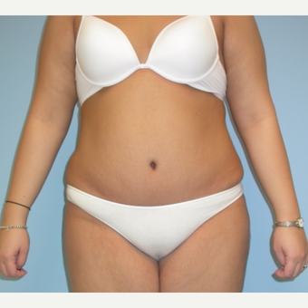 20 year old woman treated with Tummy Tuck after 3375471