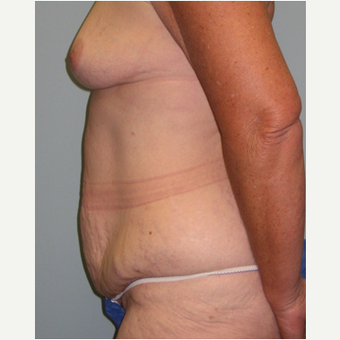 56 year old woman treated with Mommy Makeover before 3468558