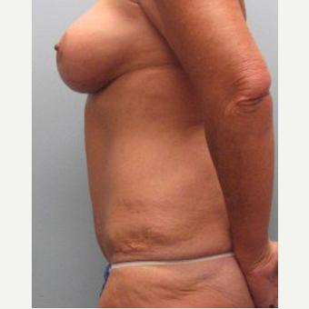 56 year old woman treated with Mommy Makeover after 3468558