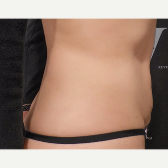 Abs after 2 cycles of CoolSculpting after 3265098