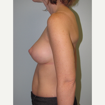 35-44 year old woman treated with Breast Lift with Implants after 3609114