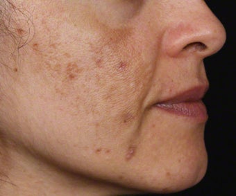 Cosmelan for Melasma and Pigmented Acne Scars before 539875