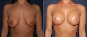 Breast lift with implants before 1380997