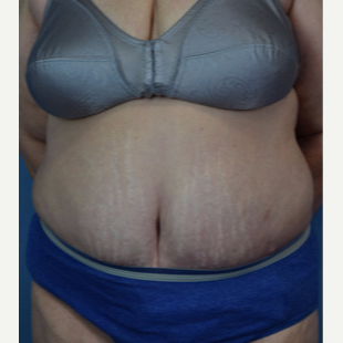 55-64 year old woman treated with Panniculectomy after 3537231
