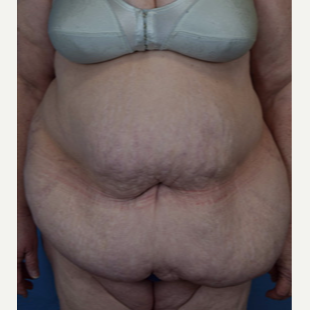 55-64 year old woman treated with Panniculectomy before 3537231
