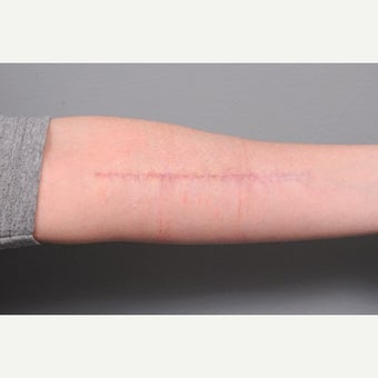 Arm Scar Revision after 1698108