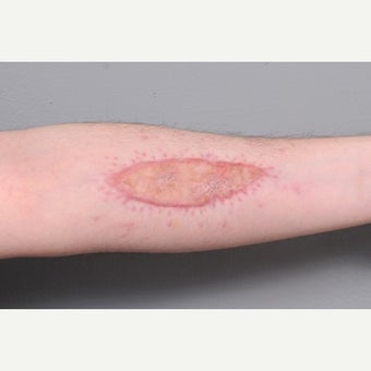 Arm Scar Revision before 1698108