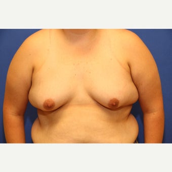 26 year old trans man treated with FTM Chest Masculinization Surgery before 2123246