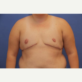 26 year old trans man treated with FTM Chest Masculinization Surgery after 2123246