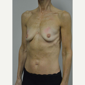 55-64 year old woman treated with Breast Implants before 3055547