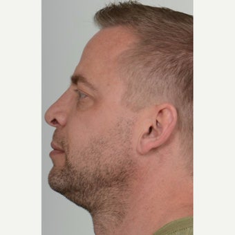 35-44 year old man treated with Teosyal Injectable filler before 2561037
